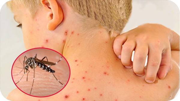 Số mắc sốt xuất huyết đã vượt 300.000 ca, lưu ý quan trọng để tránh bệnh diễn biến nặng