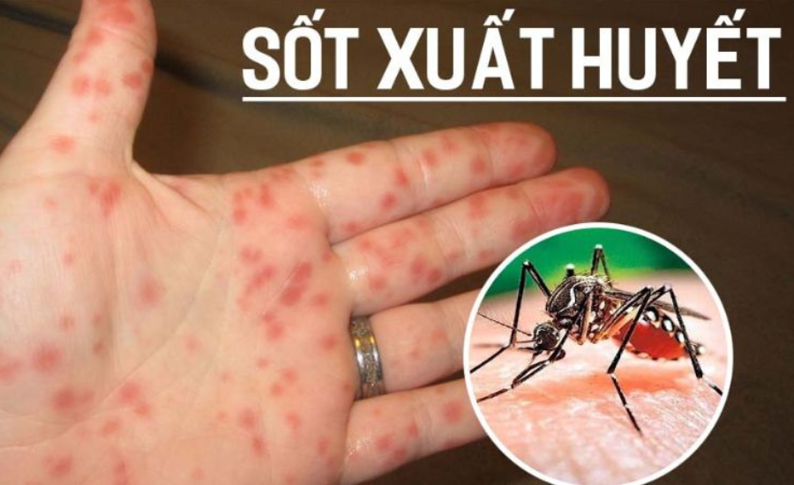 Sốt xuất huyết: Triệu chứng, nguyên nhân và phòng ngừa